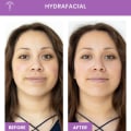 Hydrafacial From The Fountain Of Youth Med Spa