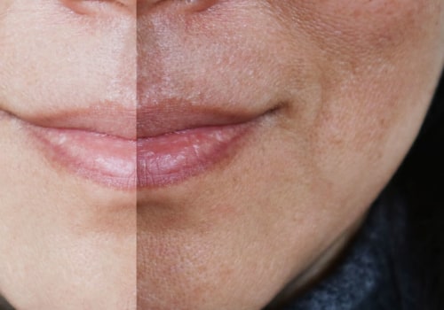 How Long Do the Benefits of HydraFacial Last?